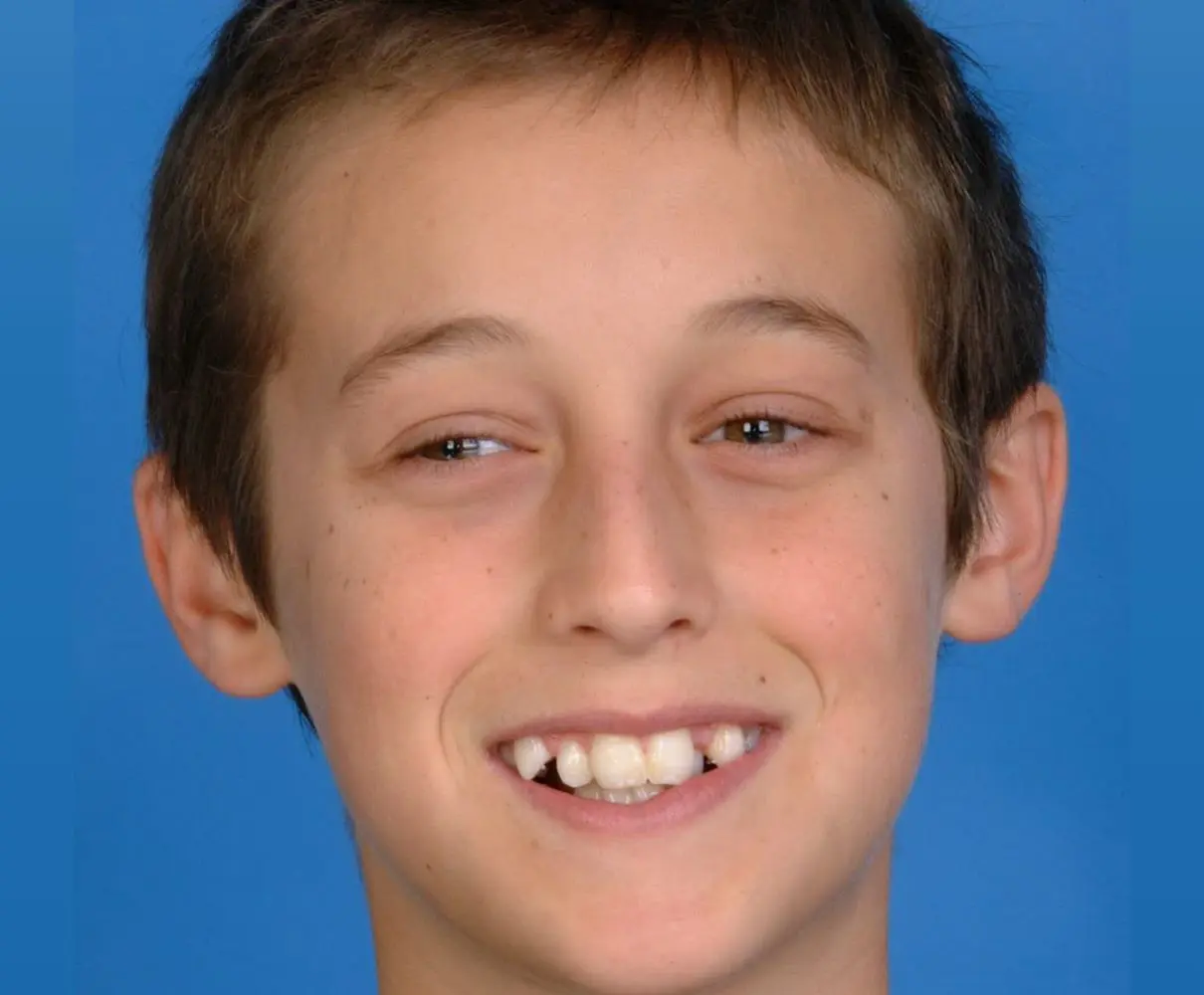 young teen smiling with imperfect teeth